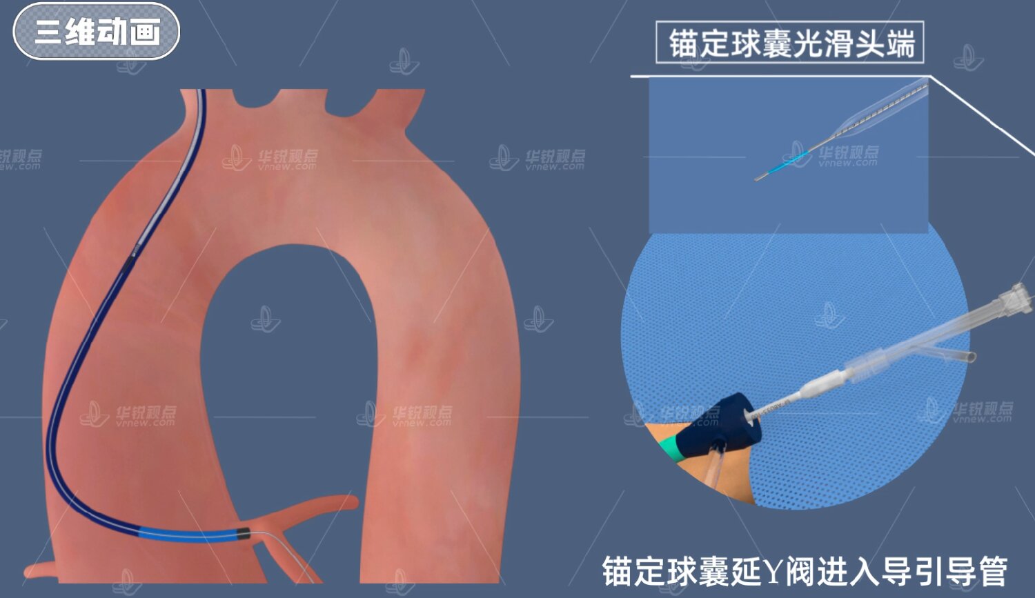 医疗器械VR锚定球囊扩张导管使用方法