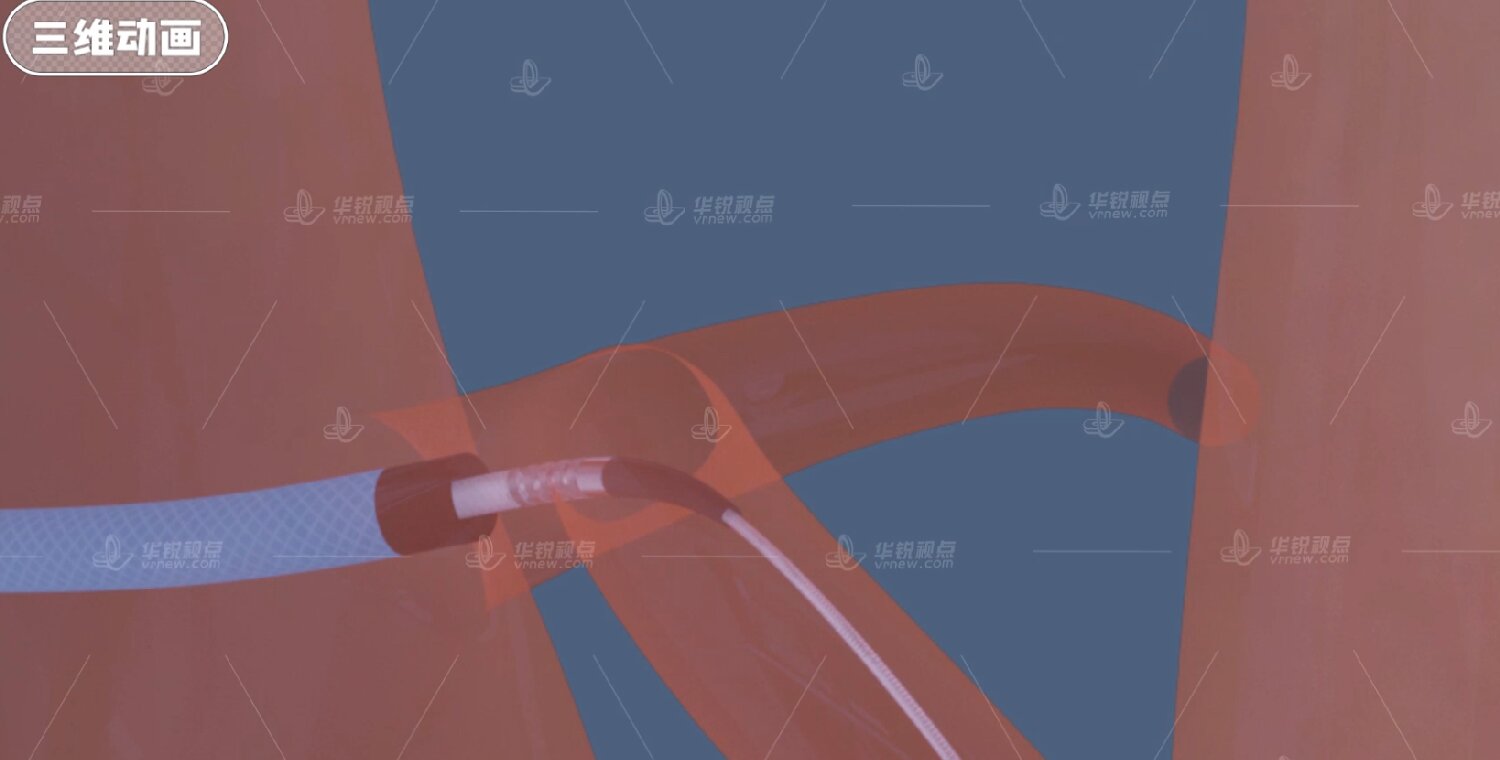 医疗器械VR锚定球囊扩张导管使用方法