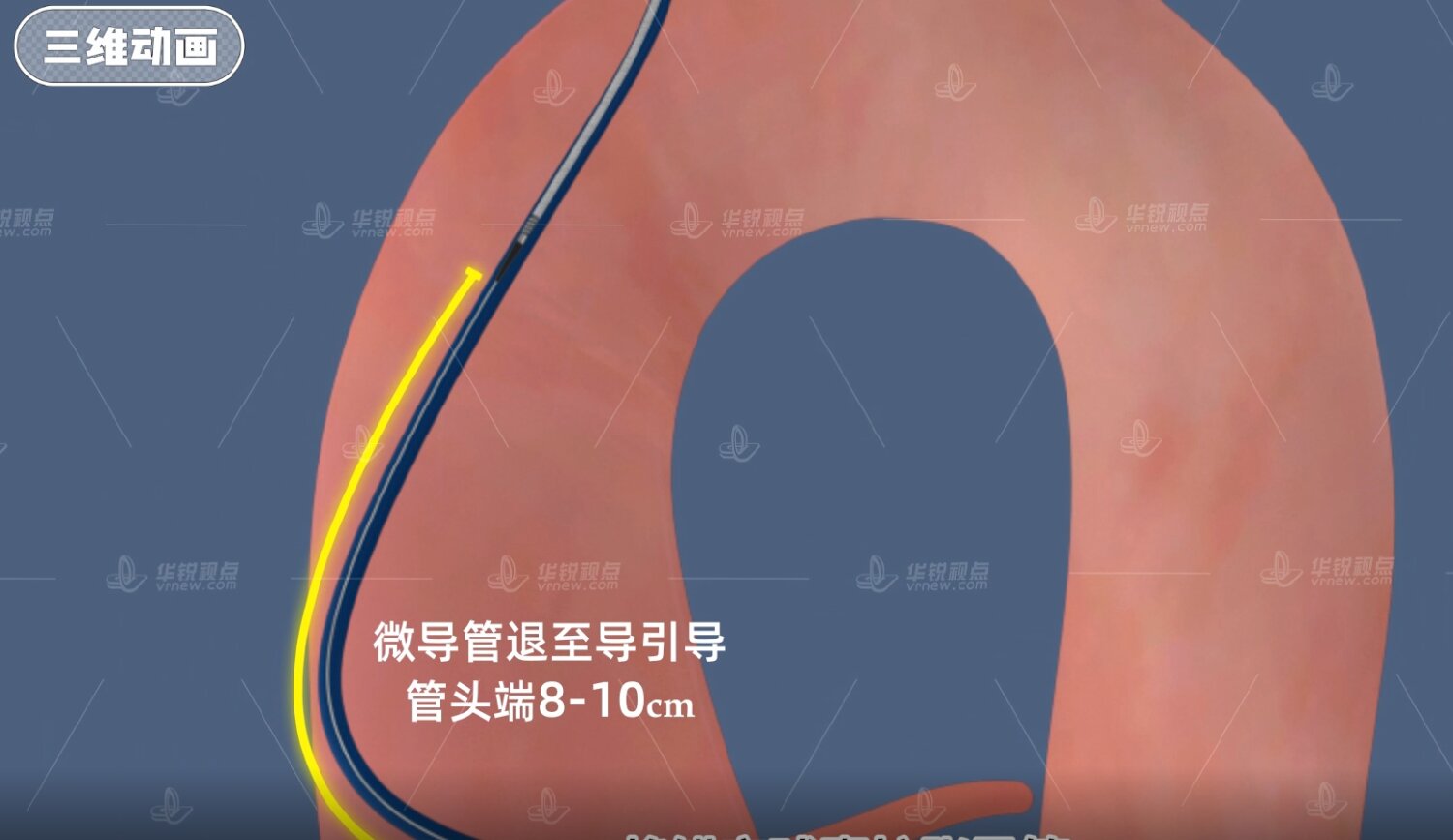 医疗器械VR锚定球囊扩张导管使用方法
