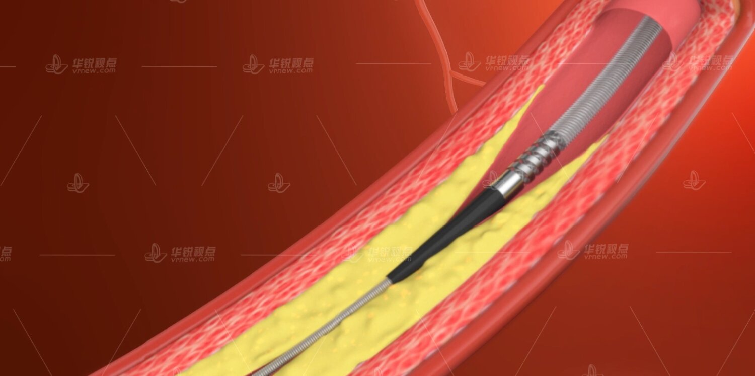 精准医疗，AR 锚定球囊扩张导管为健康护航​